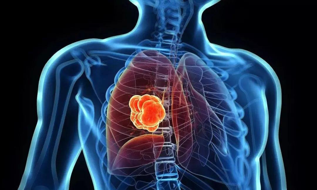 肺部疾病最新统计信息及其背后的故事揭秘