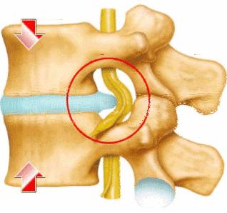 腰椎间盘突出最新治疗方法,科技重塑康复之路