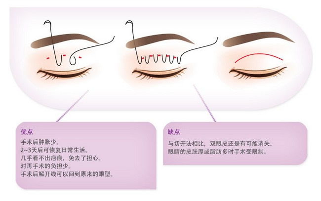 最新双眼皮整形技术，步骤指南与解析