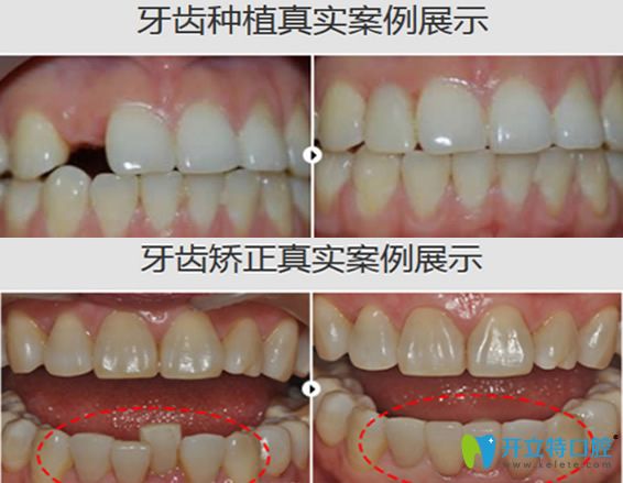 探索未来口腔健康新方向，牙齿矫正的新趋势与未来展望